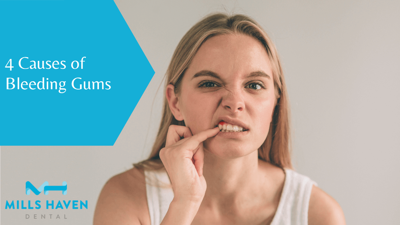 4 Causes of Bleeding Gums - Mills Haven Dental