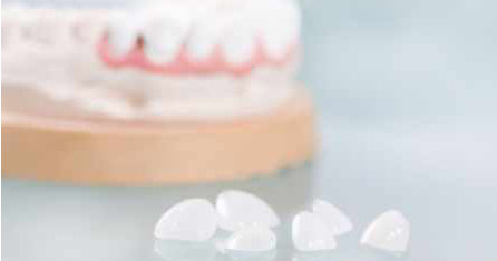 Benefits Of Porcelain Veneers - Mills Haven Dental