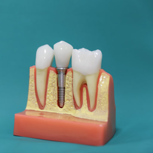 Dental implants.