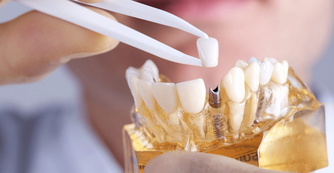 Dental Implants by the experts at Mills Haven Dental