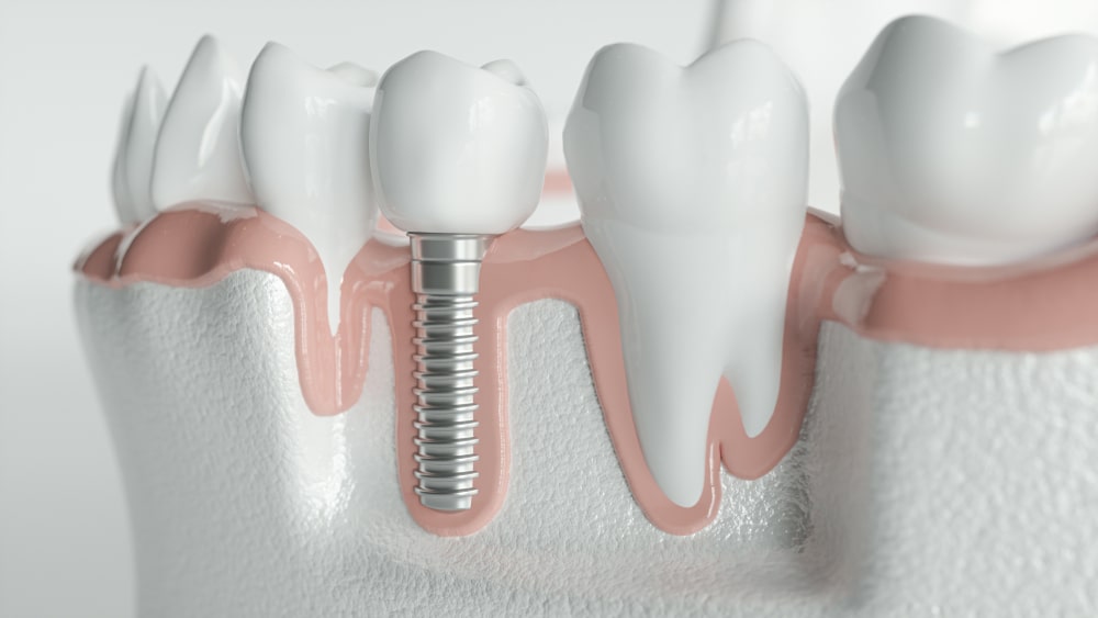 Tips for Taking Care of Dental Implants - Mills Haven Dental